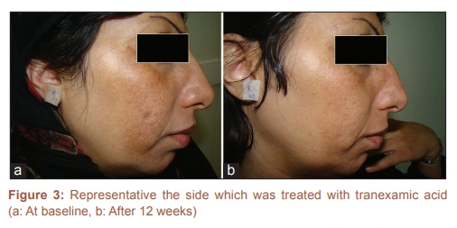 Pemakaian rutin skincare yang mengandung Tranexamic ac