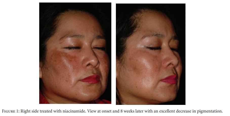 sumber : Clinical Study
A Double-Blind, Randomized Clinical Trial of Niacinamide 4%
versus Hydroquinone 4% in the Treatment of Melasma.